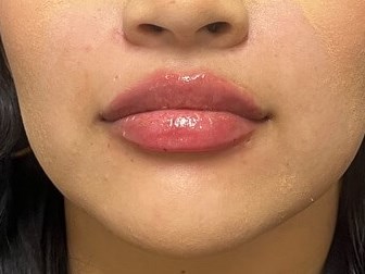 Juvederm Lip Enhancement After