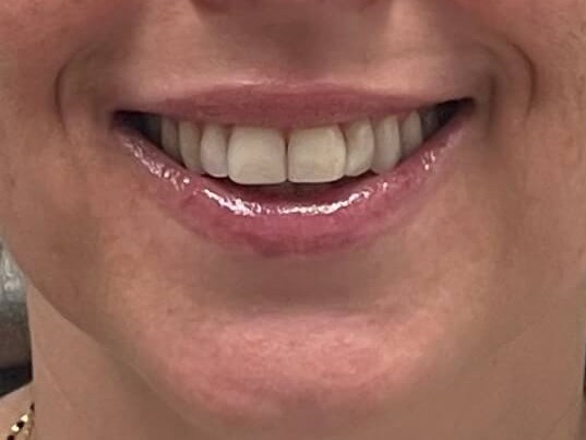 Botox Gummy Smile After