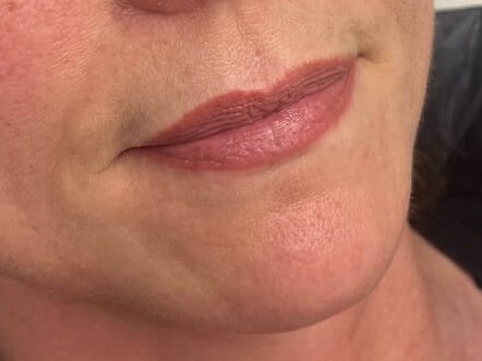 Juvederm Lip Enhancement Before