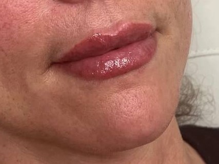 Juvederm Lip Enhancement After