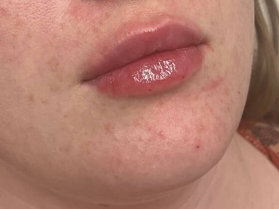 Juvederm Lip Enhancement After