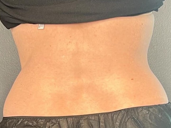Coolsculpting Flanks After