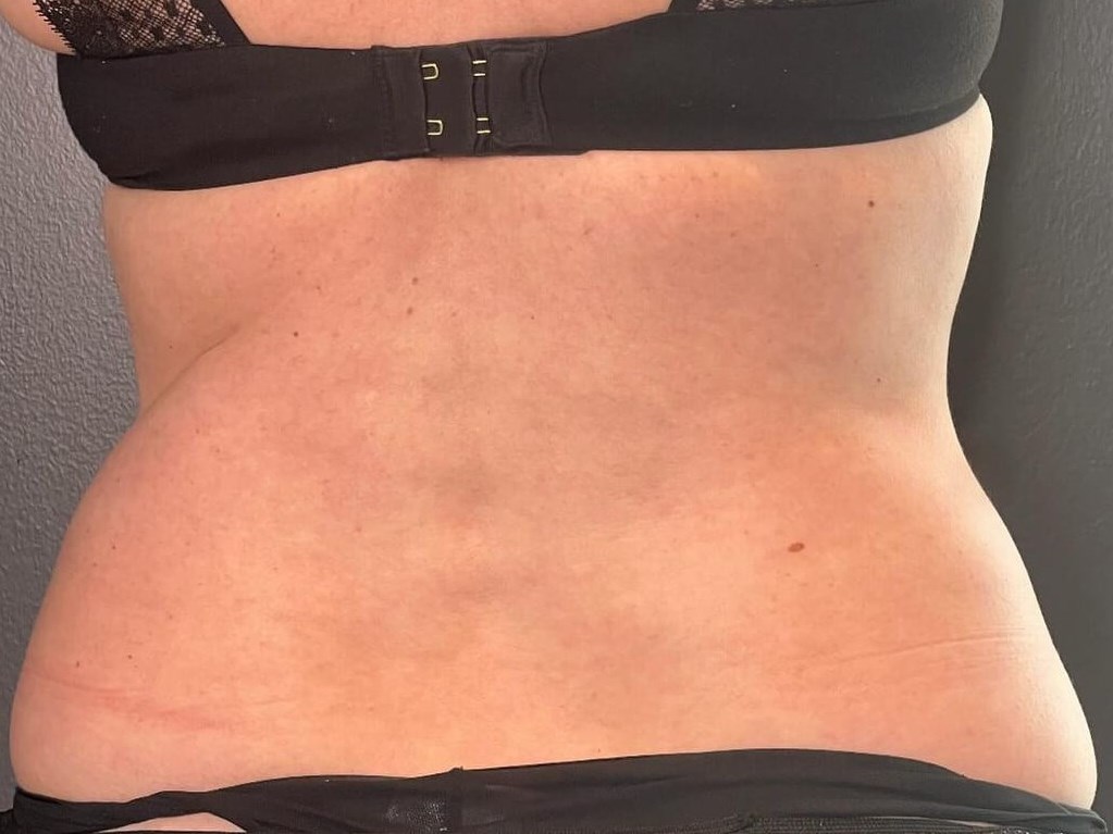 Coolsculpting Flanks Before