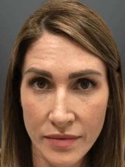 Comprehensive Facial Plan Before