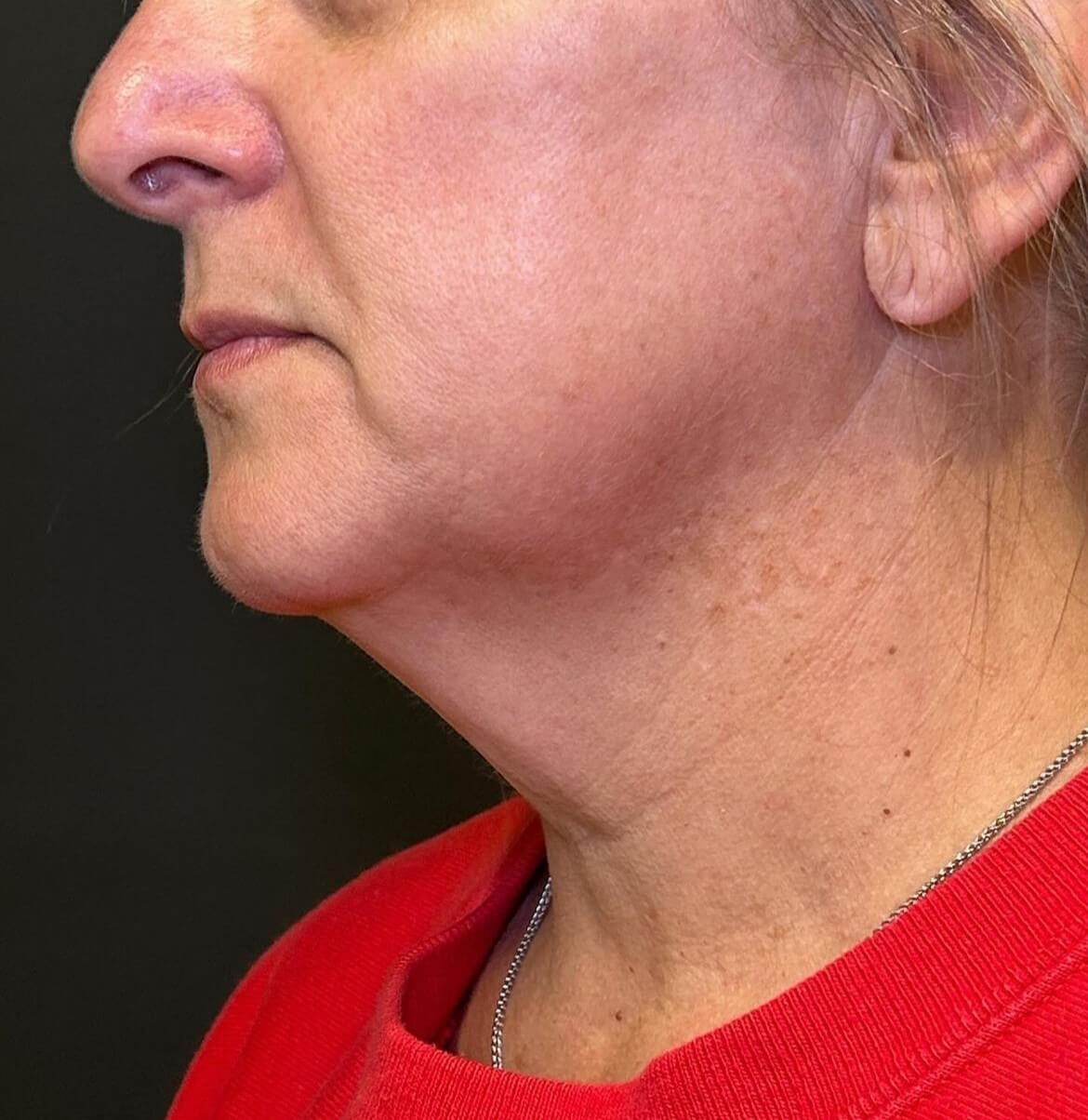 Transform Your Chin Before