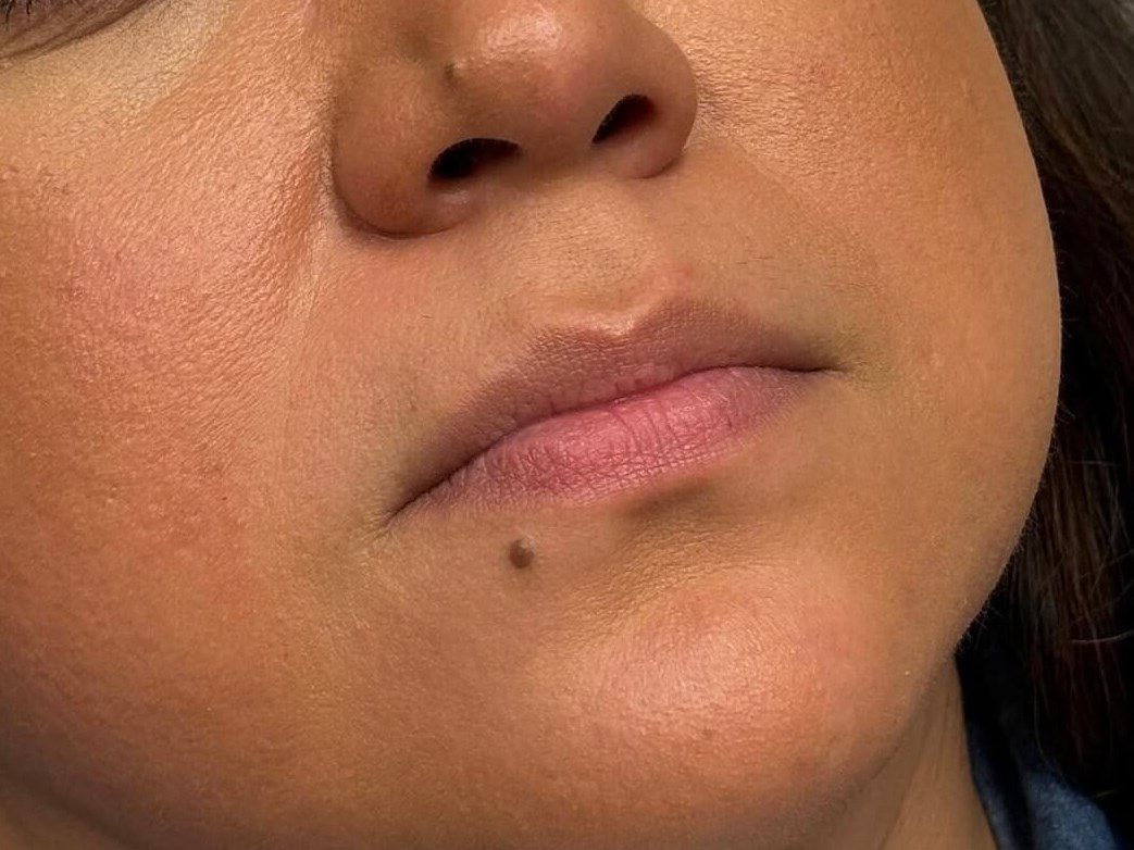 Enhancing Lips with Juvederm Before