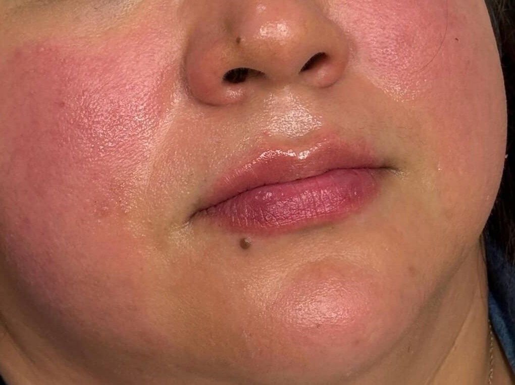 Enhancing Lips with Juvederm After