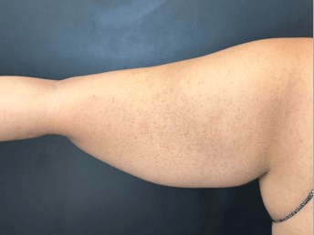 Contour and Slim Your Arms Before