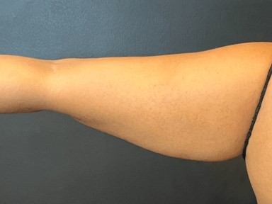 Contour and Slim Your Arms After