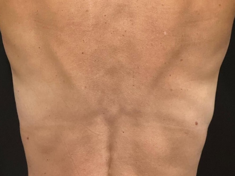 Refine Your Back After