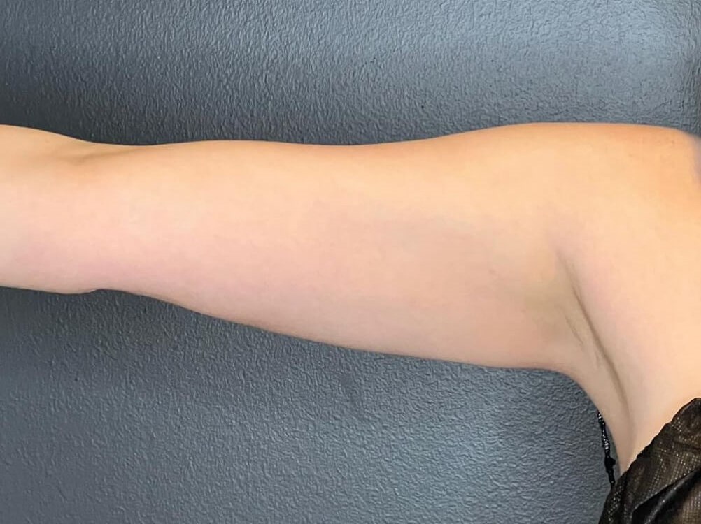 Transform Your Arms After