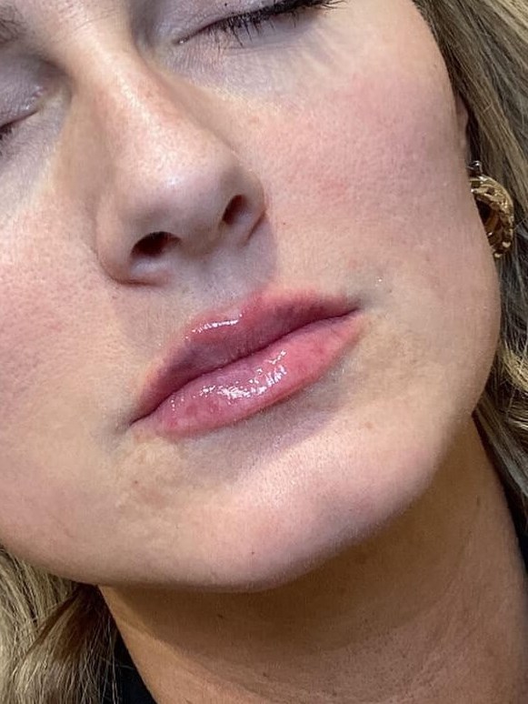 Enhance Your Lips After
