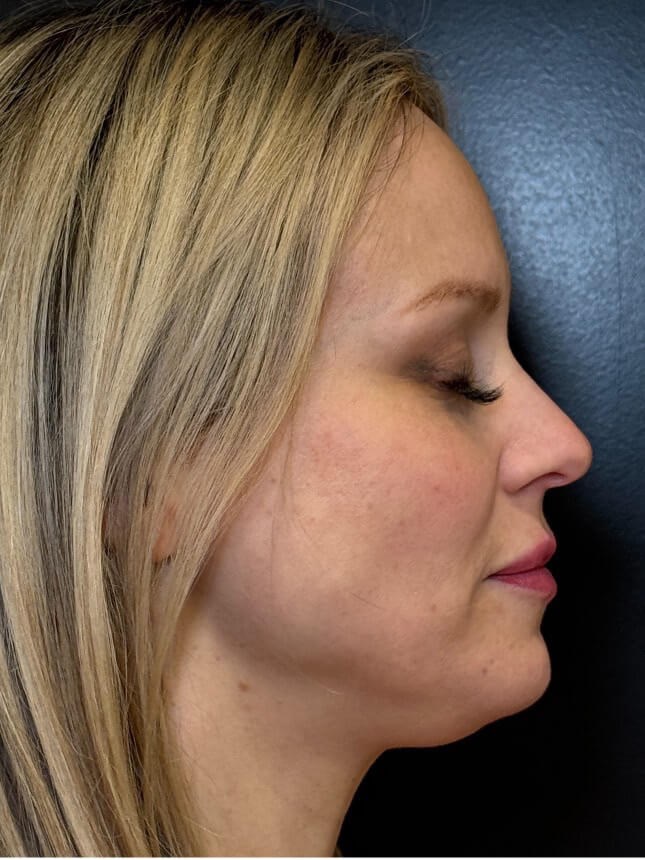 Emface Treatment Before