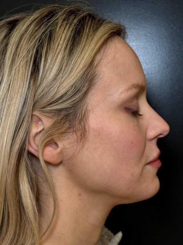 Emface Treatment After
