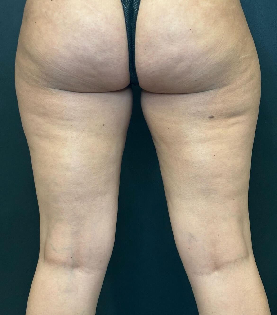 Sculpt your Inner Thighs Before
