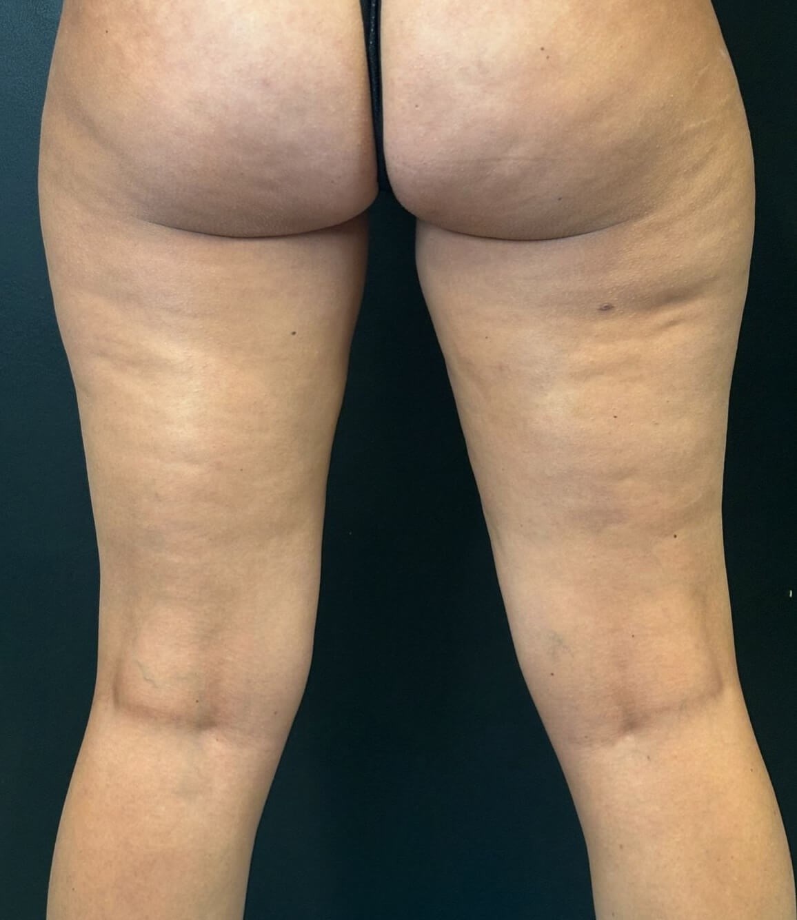 Sculpt your Inner Thighs After