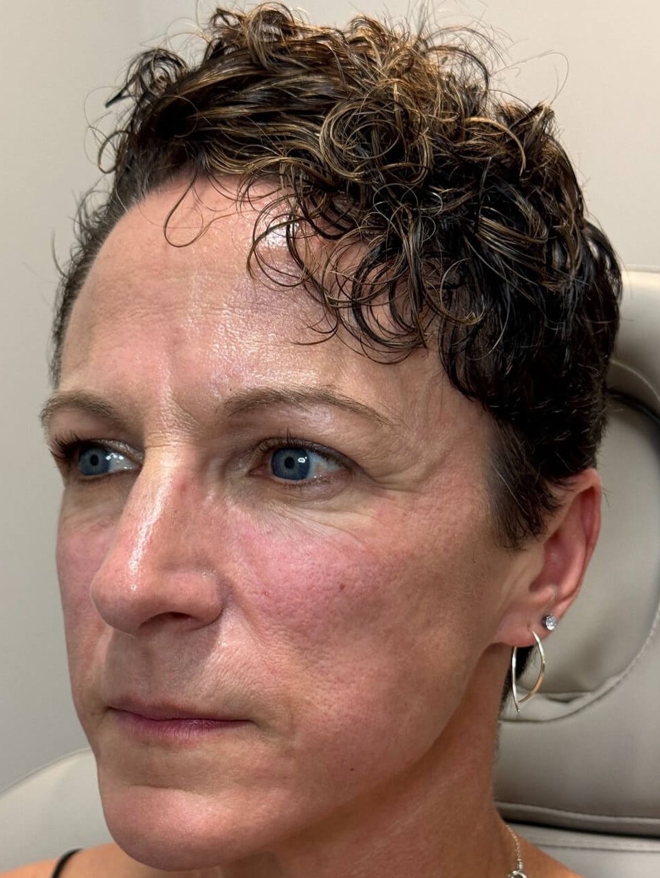 Achieving a youthful glow After