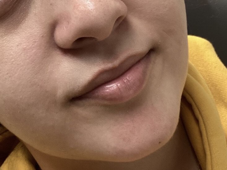 Juvederm Lip Enhancement Before