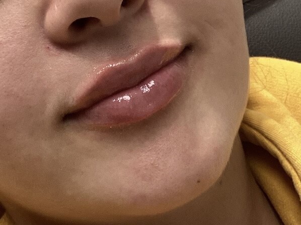 Juvederm Lip Enhancement After