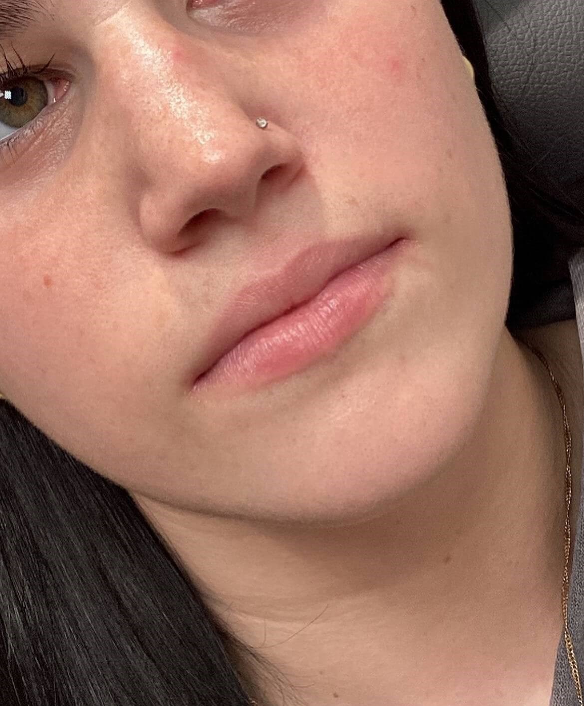 Juvederm Ultra Lips Before