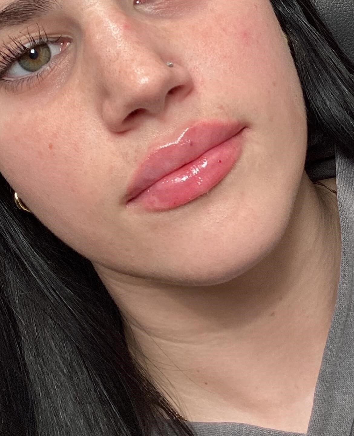 Juvederm Ultra Lips After