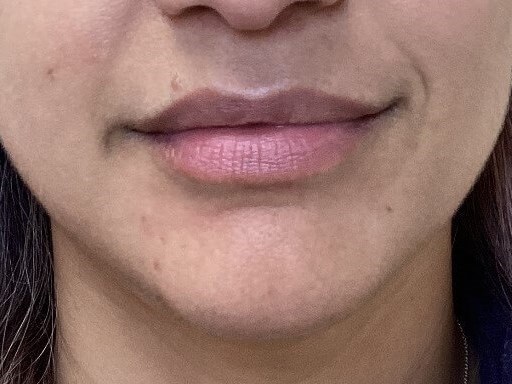 Juvederm Ultra Lips Before