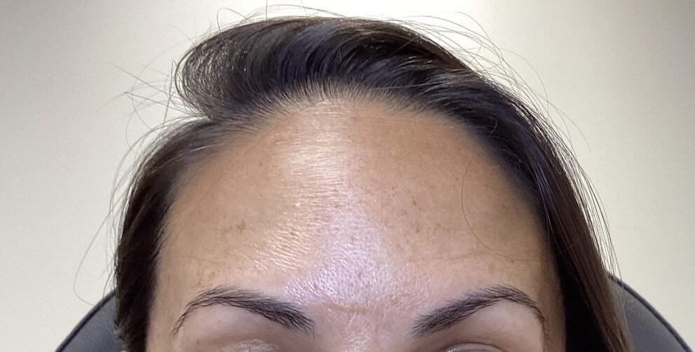 Forehead Botox After