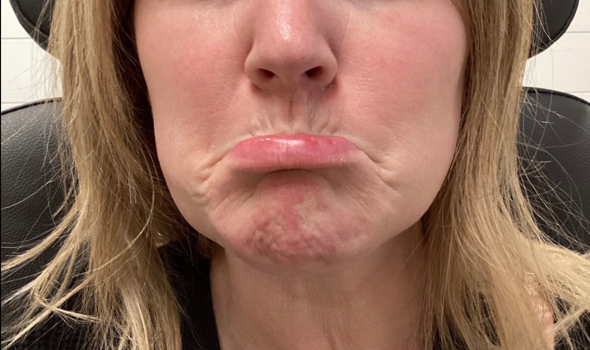 Chin Botox Before