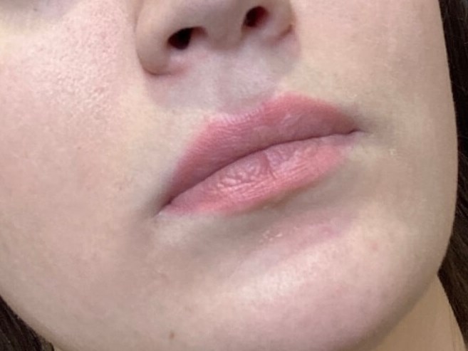 Juvederm Ultra Lips Before