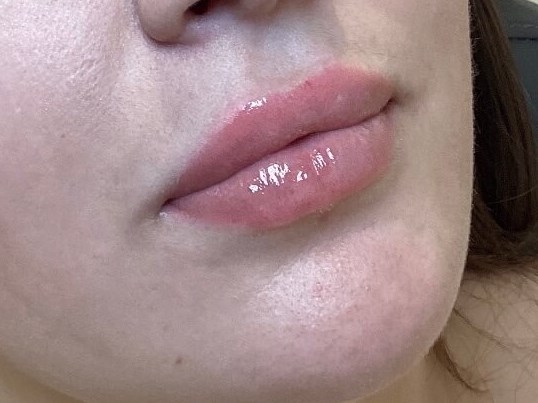 Juvederm Ultra Lips After