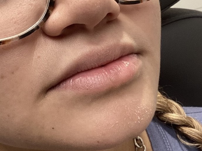 Juvederm Ultra Lip Enhancement Before