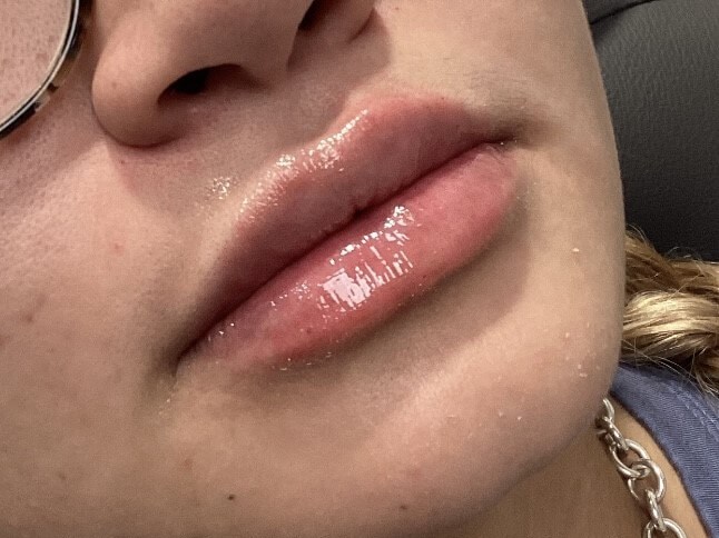 Juvederm Ultra Lip Enhancement After