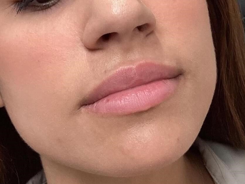 Achieve Beautiful Lips Before