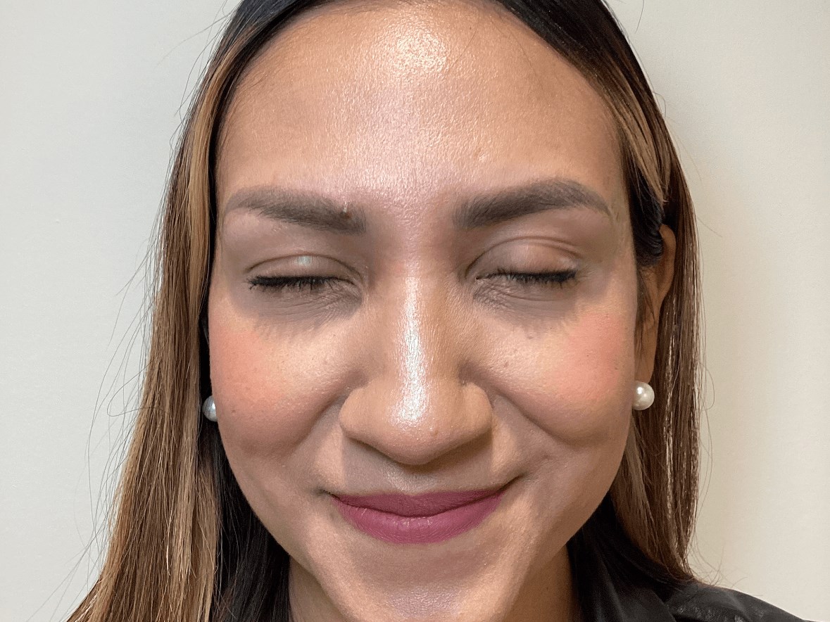 Forehead Botox After