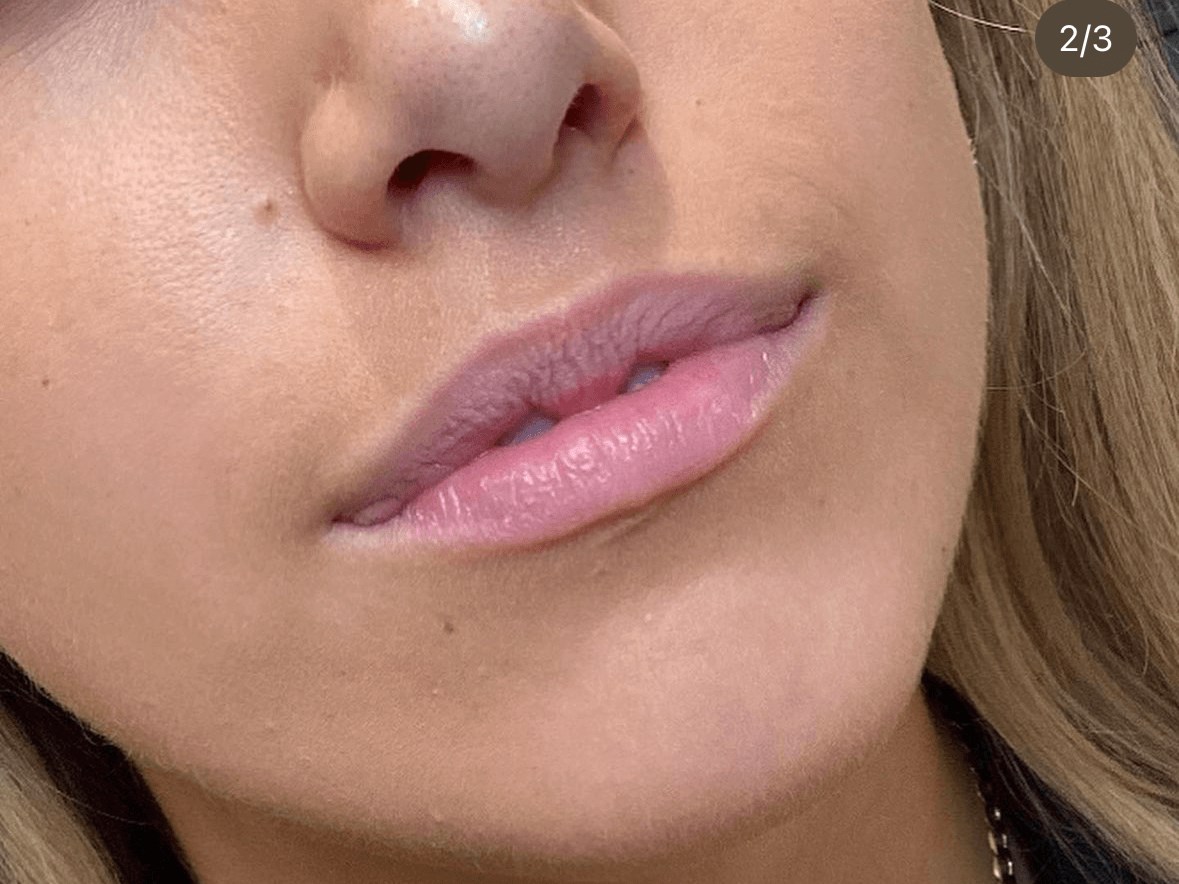 Juvederm Ultra Lips Before