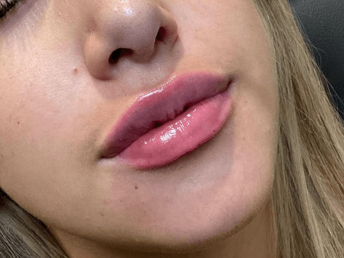 Juvederm Ultra Lips After