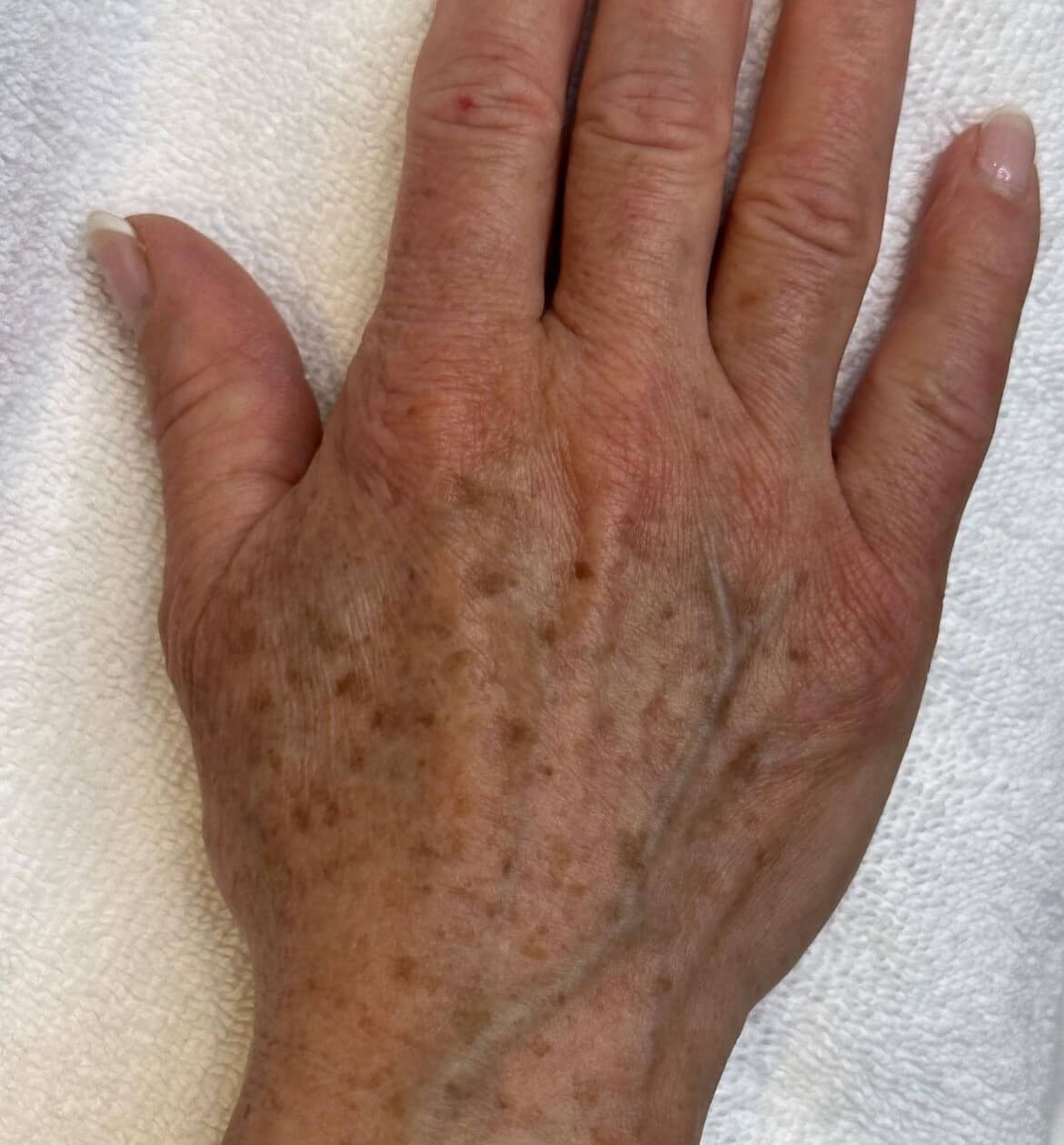 Hand Rejuvenation with BBL Before