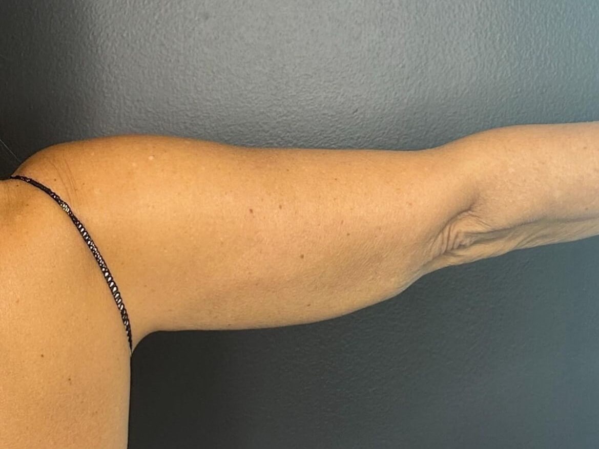 Slim Arms with CoolSculpting After