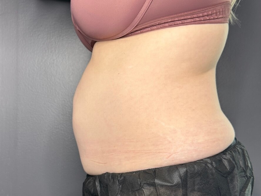 Coolsculpt Abdomen Before
