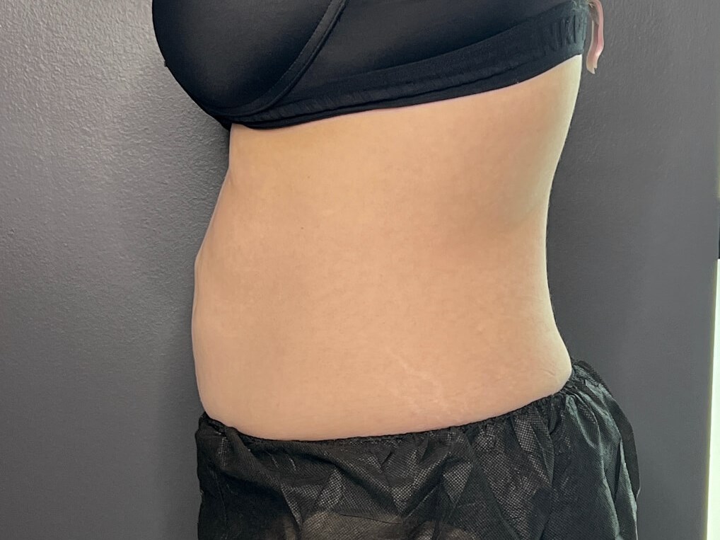 Coolsculpt Abdomen After