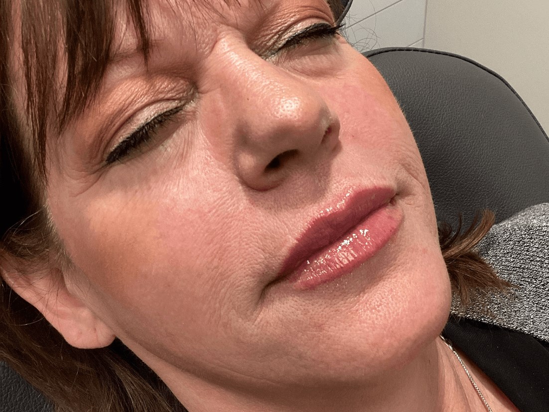 Beautiful Volbella Lips After