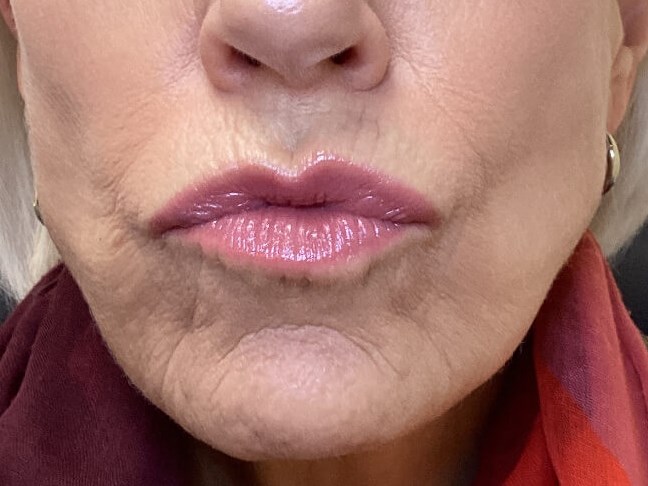 Complete Lip Rejuvenation After