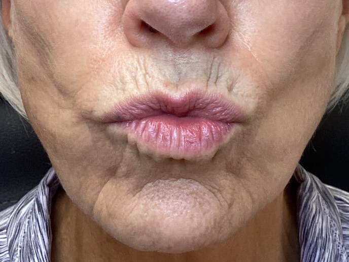 Complete Lip Rejuvenation Before