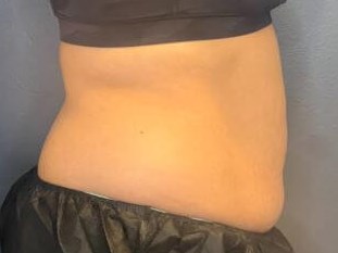 Non-Invasive Body Contouring After