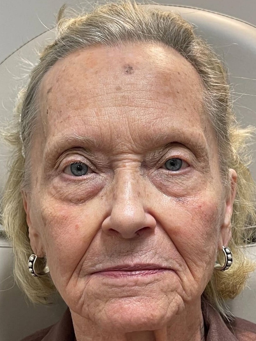 Rejuvenation for Mature Skin Before