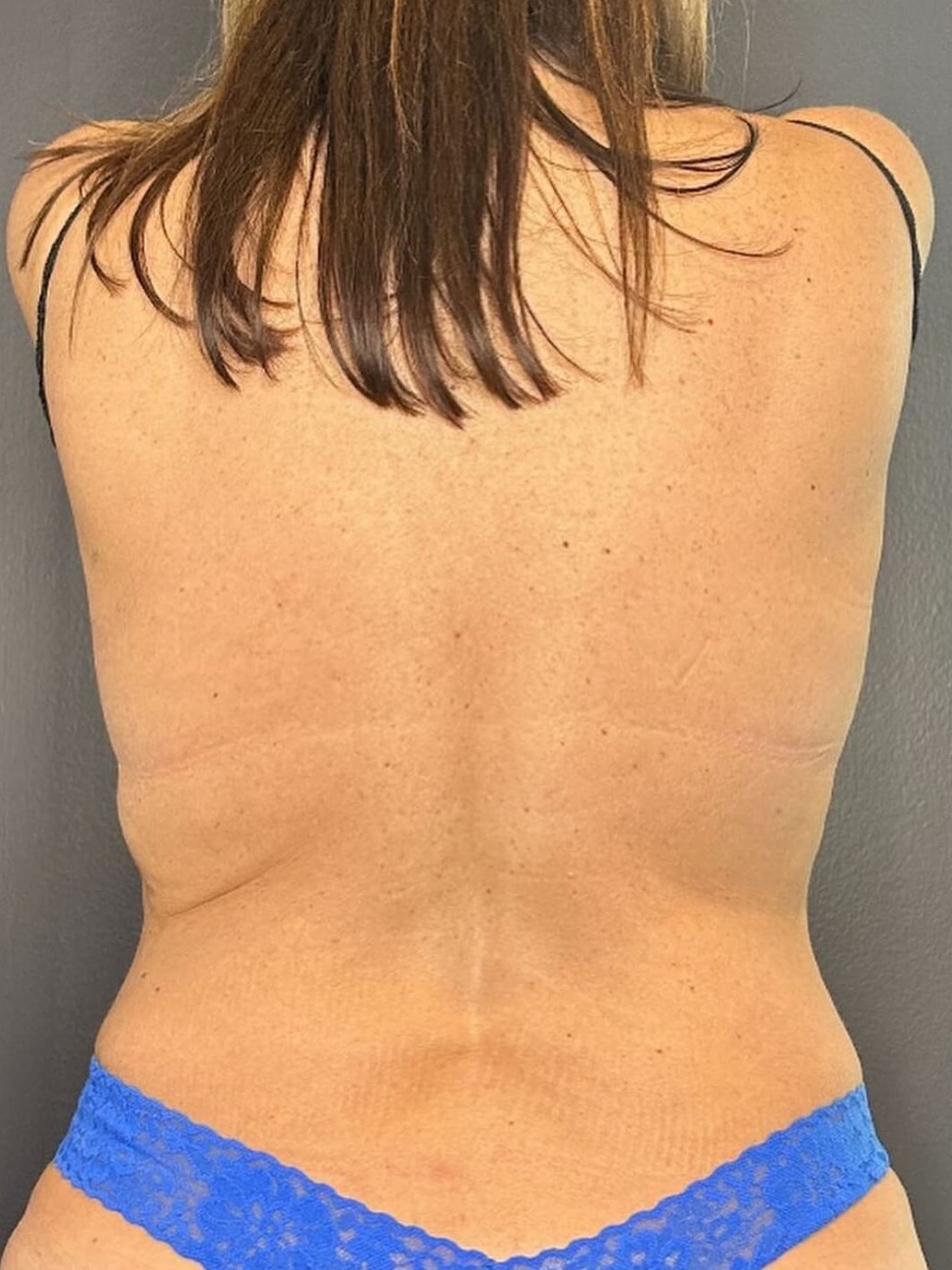 Freeze Away Stubborn Fat After