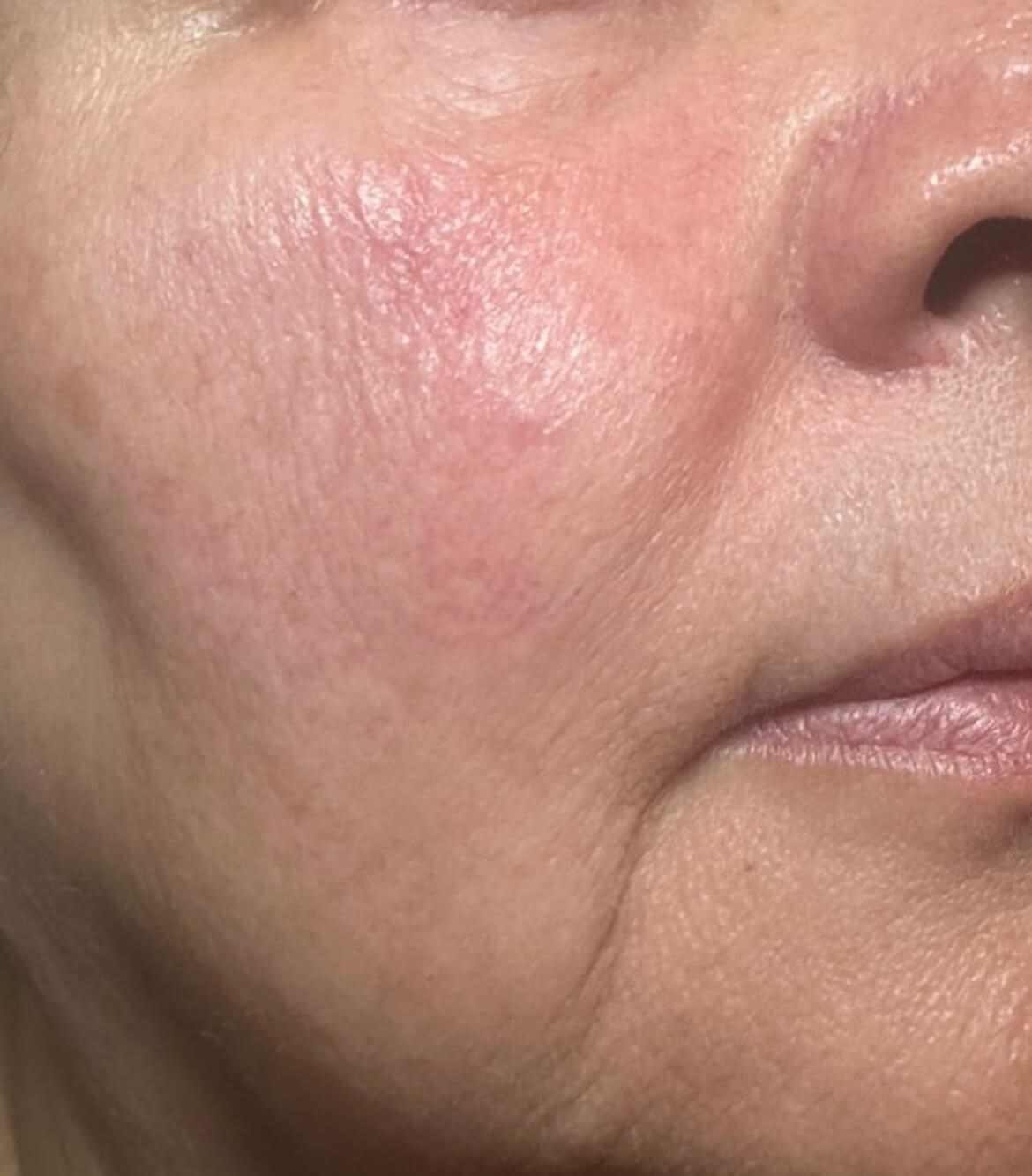 Clear & Even Skin with BBL After