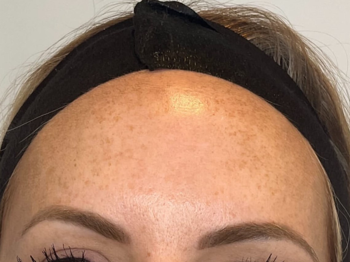Brighten your Skin with BBL Before