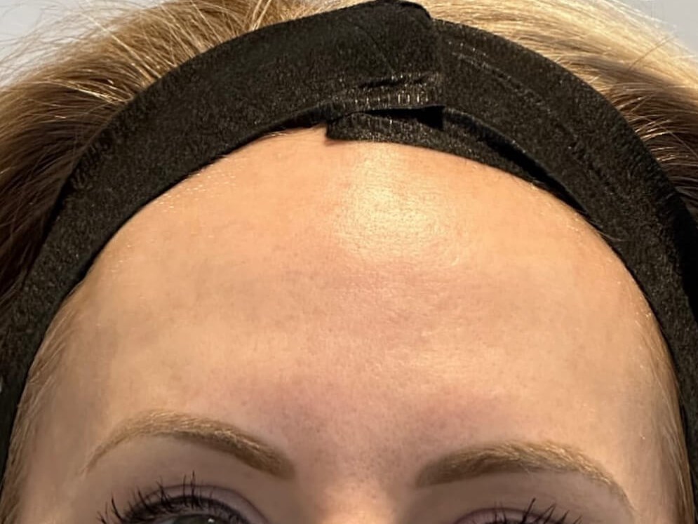 Brighten your Skin with BBL After