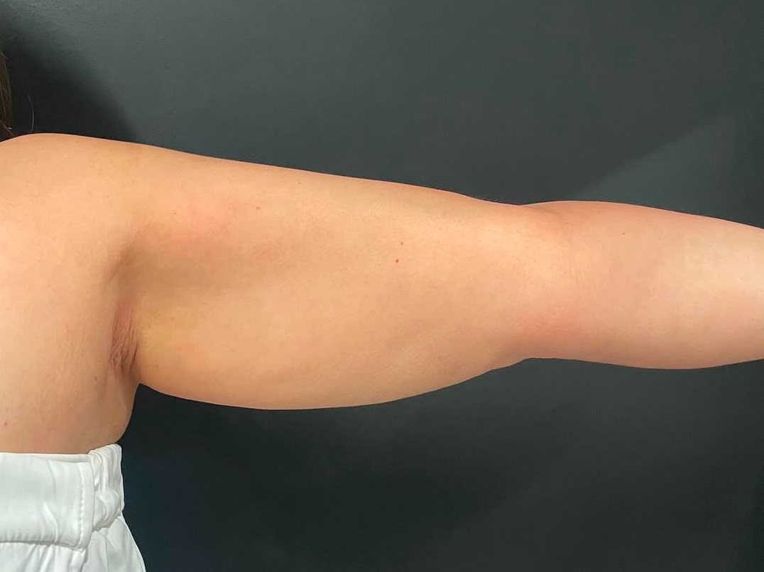 Contour and Tone Your Arms Before